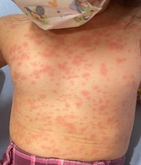 measles rash on chest and stomach of a child